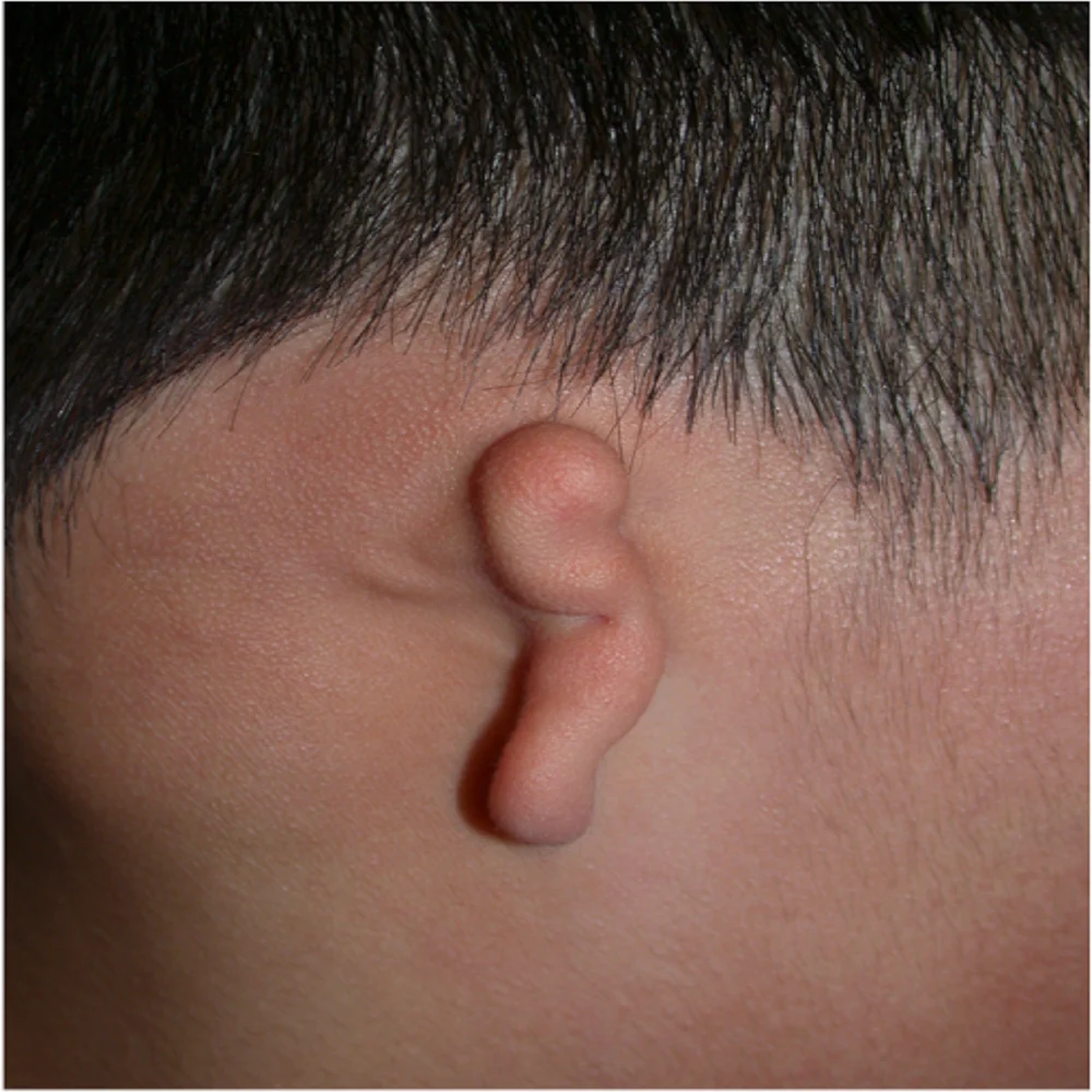 Microtia_2 μικρωτία