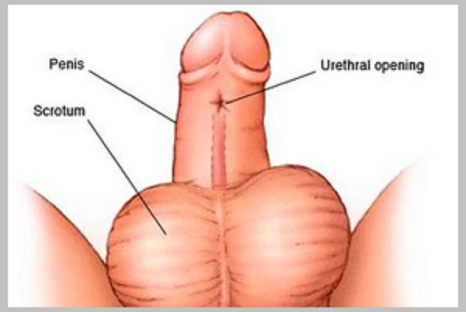 hypospadias-surgery_2 υποσπαδίας