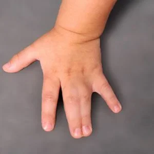 syndaktyly_2 συνδακτυλία