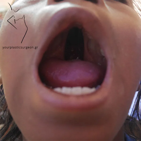 Ipersoiosxistia-600x600 Λυκόστομα (υπερωιοσχιστία)