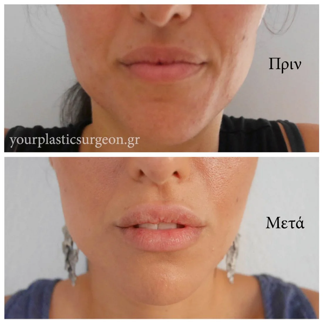 Ιστορία αυξητικής χειλιών