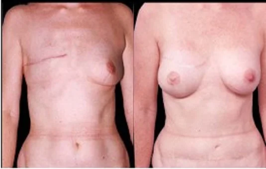 αποκατάσταση μαστού