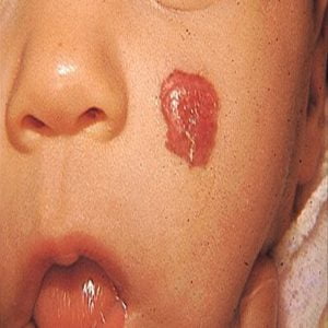 hemangioma_3 αιμαγγείωμα