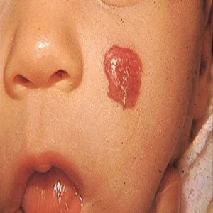 hemangioma_3 αιμαγγείωμα