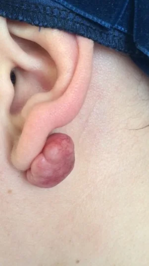 Χηλοειδή - υπερτροφικές ουλές