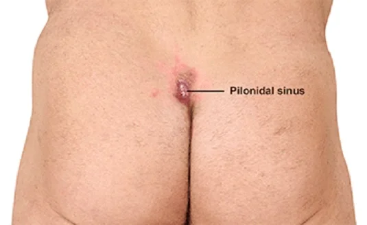 Κύστη Κόκκυγος