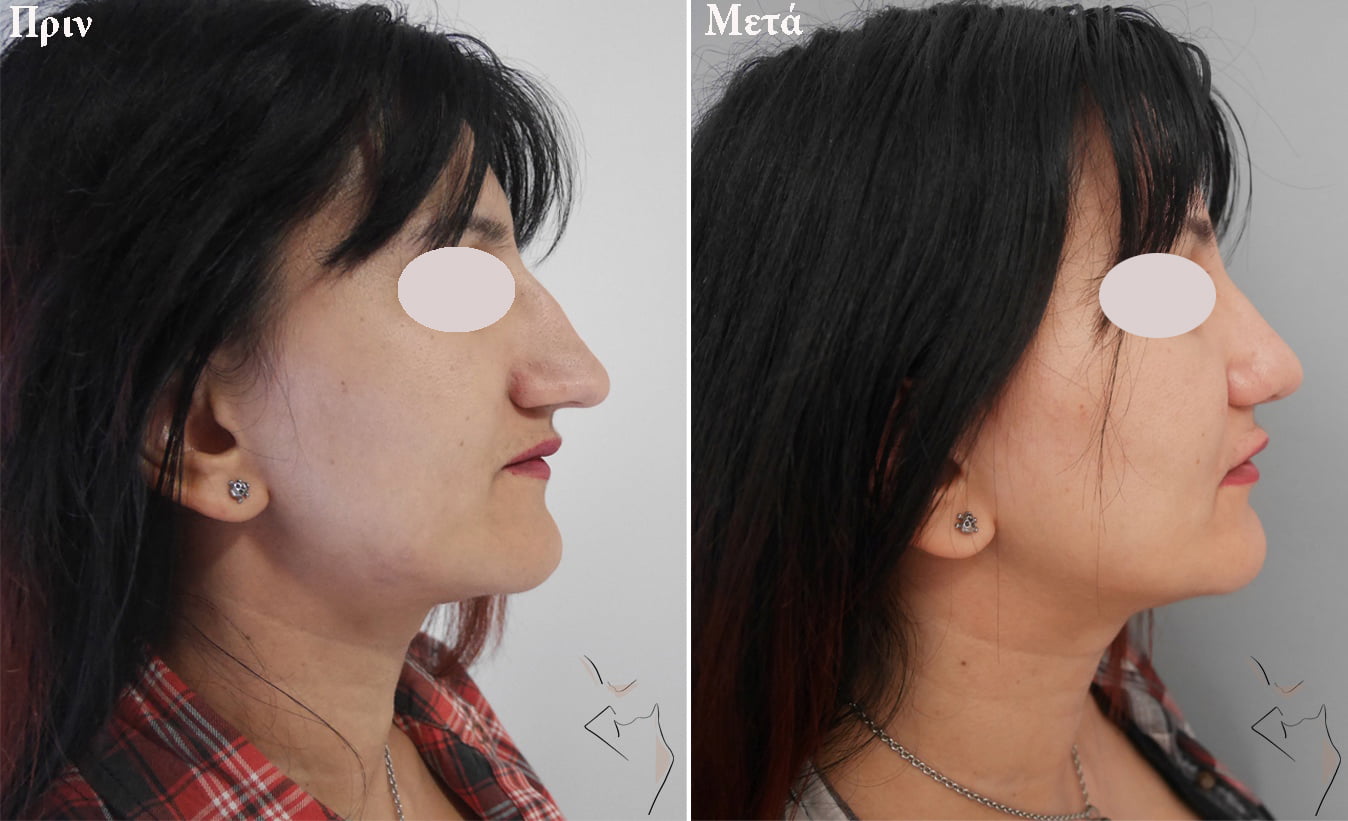 rinoplastic_before_after ρινοπλαστική θεσσαλονίκη