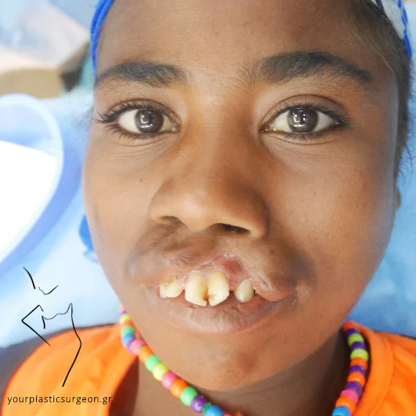 xeilosxistia600x600 Λαγόχειλο | Χειλεοσχιστία