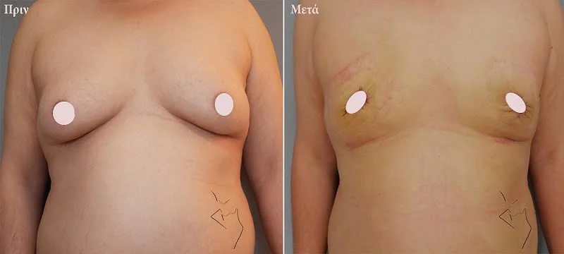 Γυναικομαστία Θεσσαλονίκη