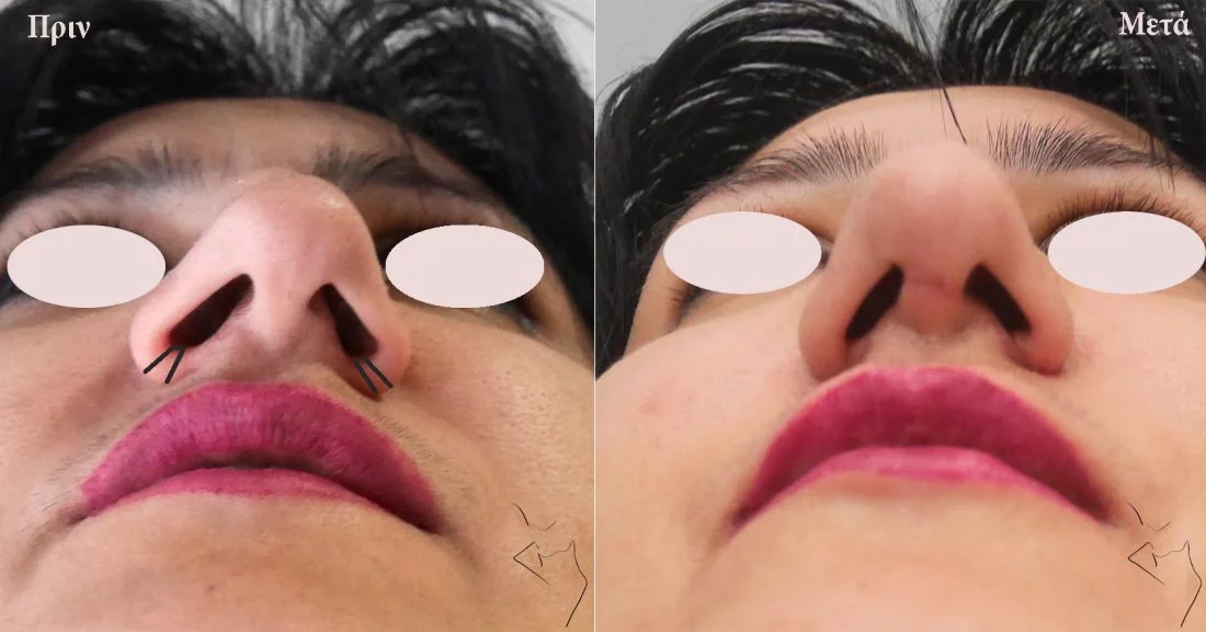 Μείωση των ρουθουνιών