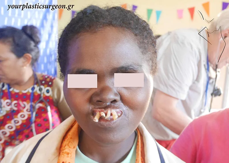 Είναι κληρονομικό το λαγώχειλο;