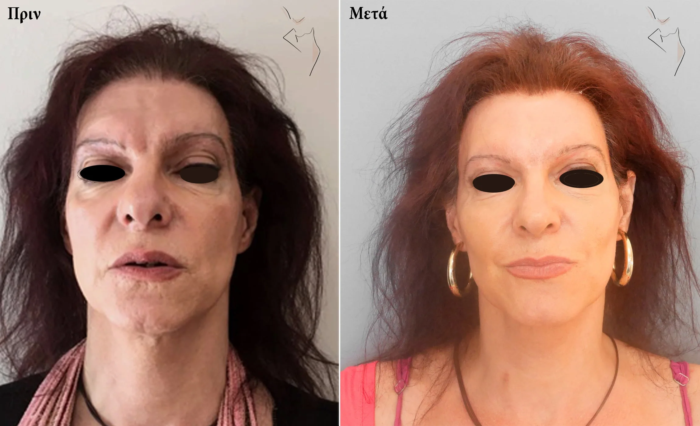 Aλλαγή φύλου