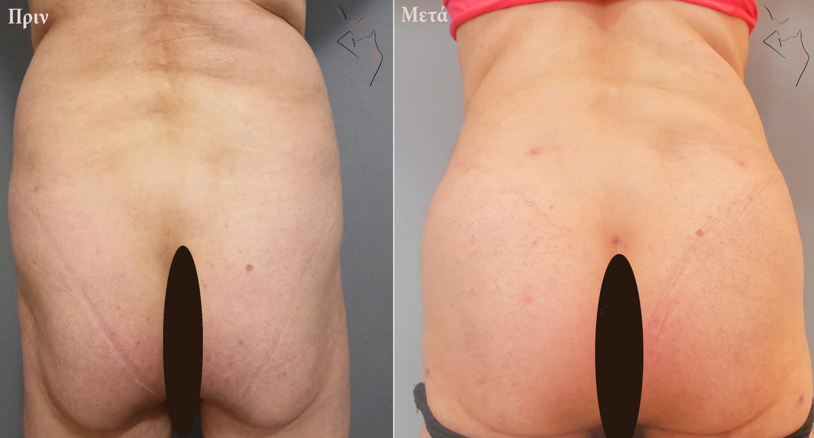 Ανόρθωση γλουτών Θεσσαλονίκη