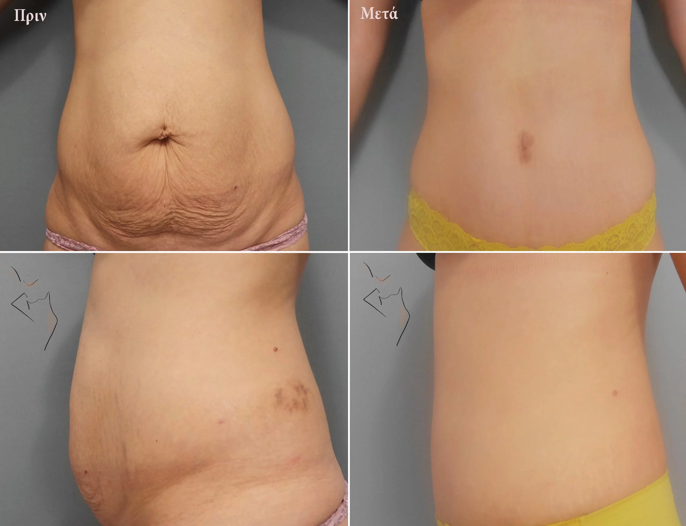 Κοιλιοπλαστική Θεσσαλονίκη