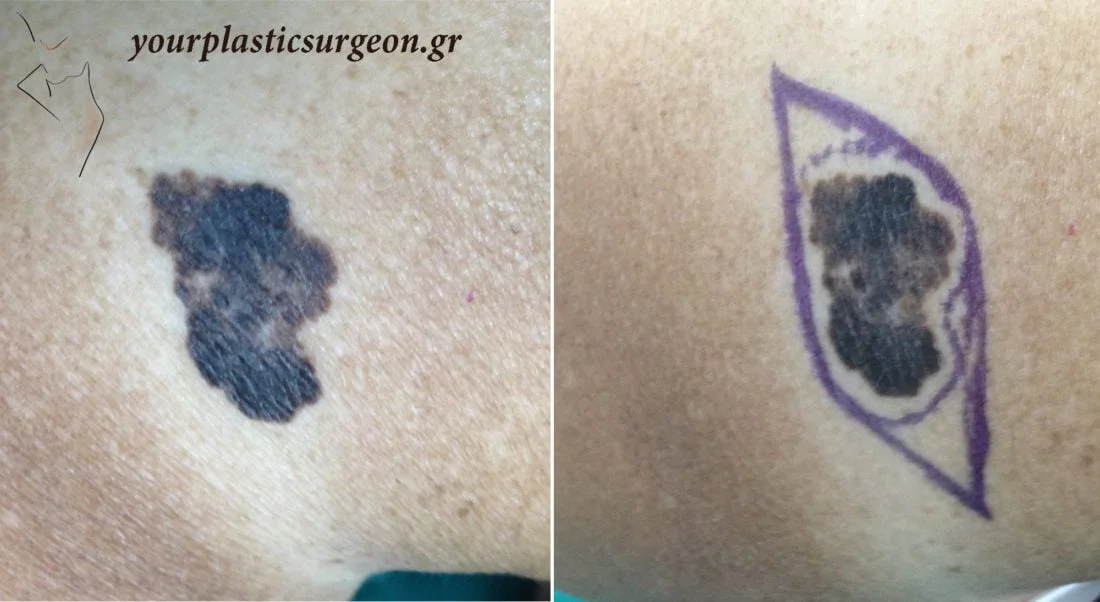 μελάνωμα δέρματος