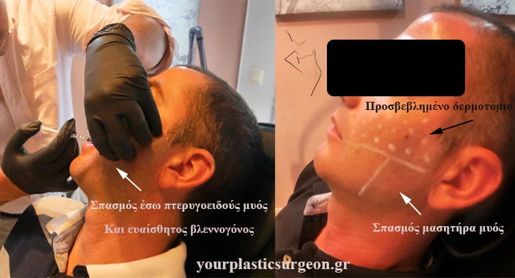 νευραλγία τριδύμου μπότοξ