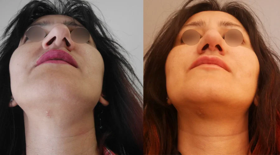 Πλαστική μύτης Θεσσαλονίκης