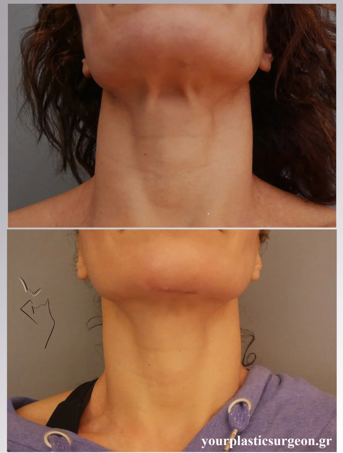 λίφτινκ λαιμού