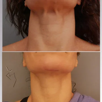 λίφτινκ λαιμού