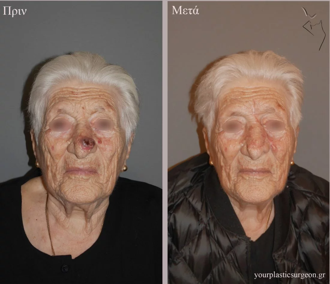 ακανθοκυτταρικό καρκίνωμα