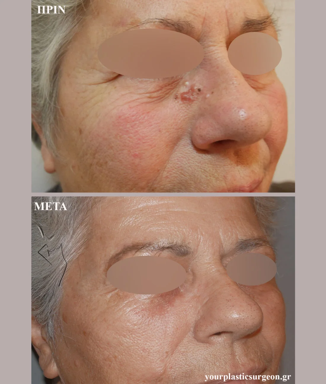 βασικοκυτταρικό καρκίνωμα