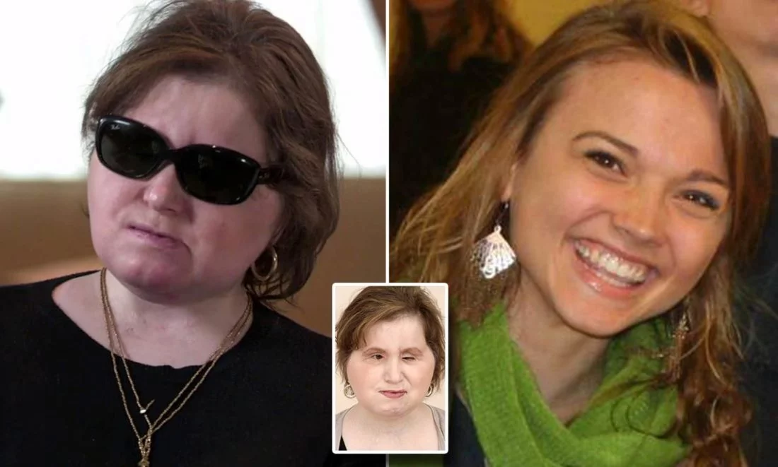 Μεταμόσχευση προσώπου