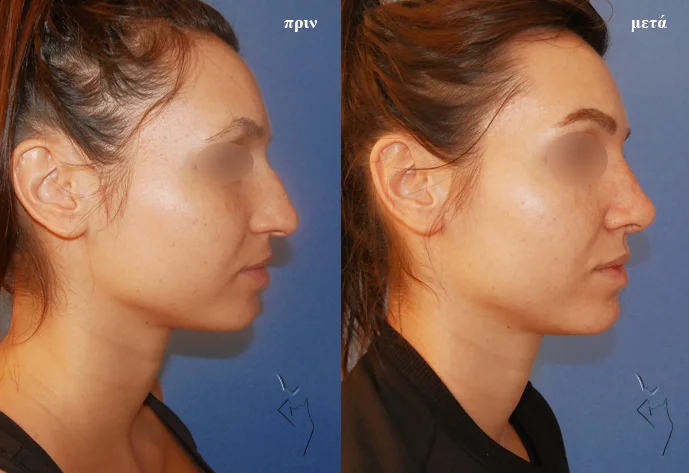 plastiki-mitis-prin-kai-meta-profil πλαστική μύτης πριν και μετά