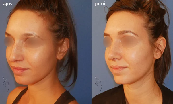 plastiki-mitis-prin-kai-meta πλαστική μύτης πριν και μετά