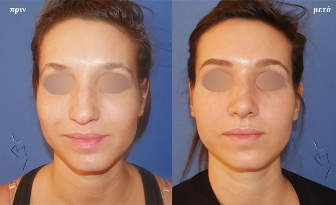 rinoplastiki-before-and-after-anfas ρινοπλαστική πριν και μετά