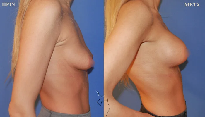 αυξητική μαστών