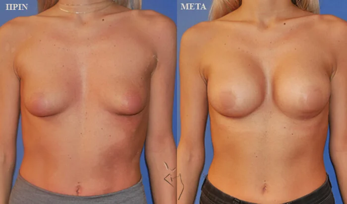 αυξητική μαστών