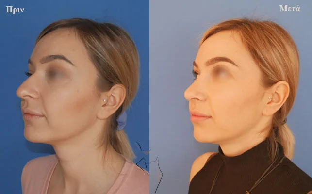 plastiki-mitis-thessaloniki ρινοπλαστική θεσσαλονίκη