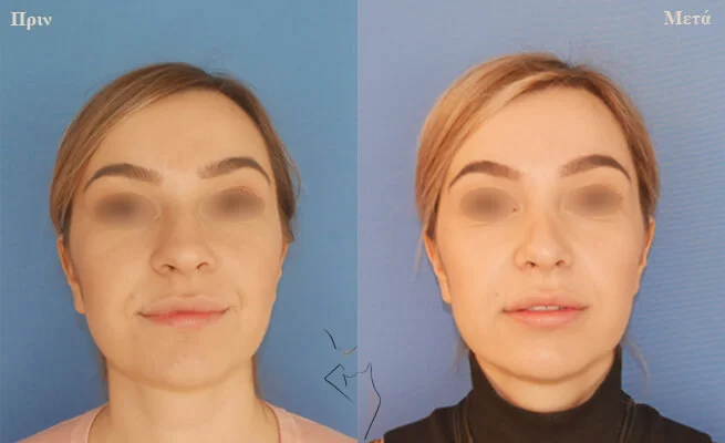 rhinoplasty-thessaloniki ρινοπλαστική θεσσαλονίκη