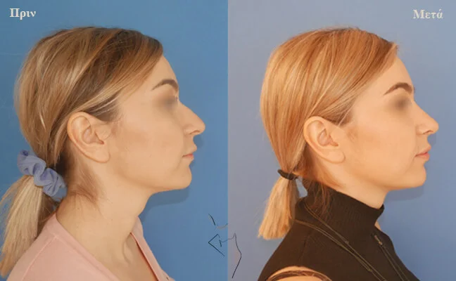 rinoplastiki-thessaloniki ρινοπλαστική θεσσαλονίκη