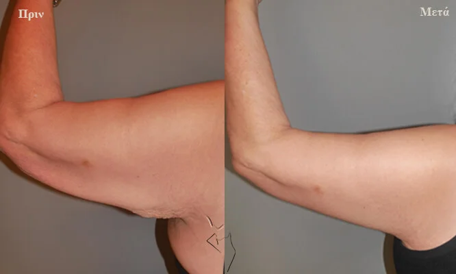 vraxionoplastiki-prin-kai-meta βραχιονοπλαστική πριν και μετά