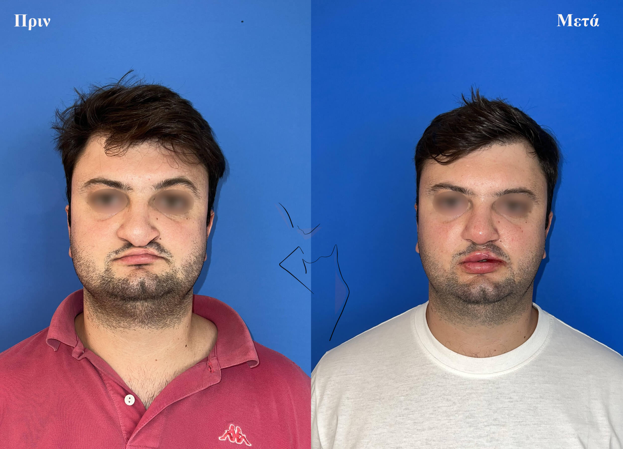 ρινοπλαστική2 (1)