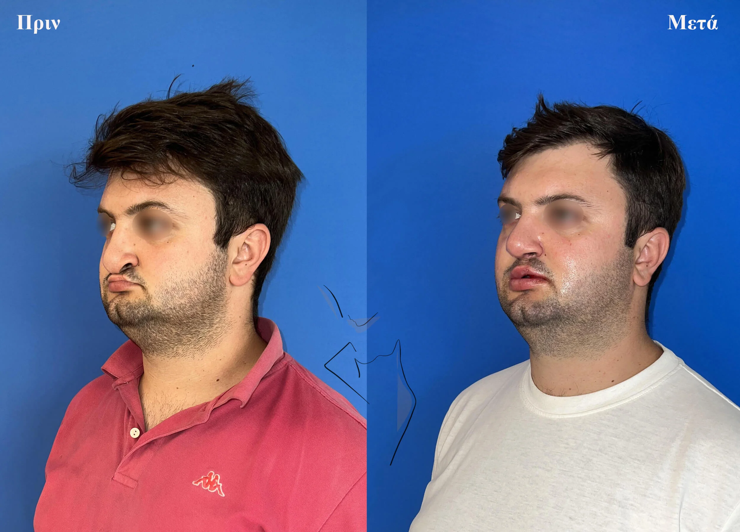 ρινοπλαστική3 (1)