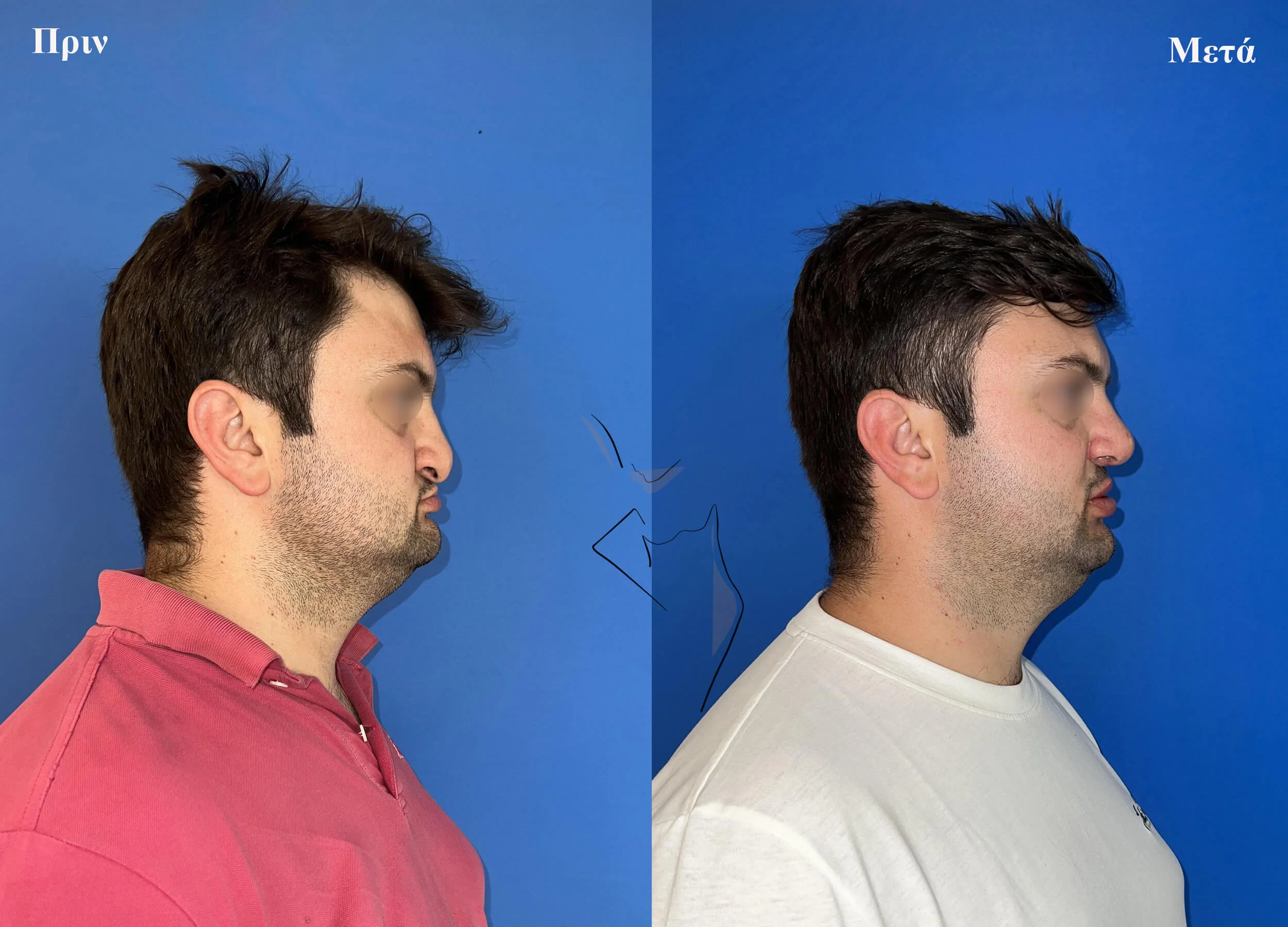 ρινοπλαστικη1 (1)