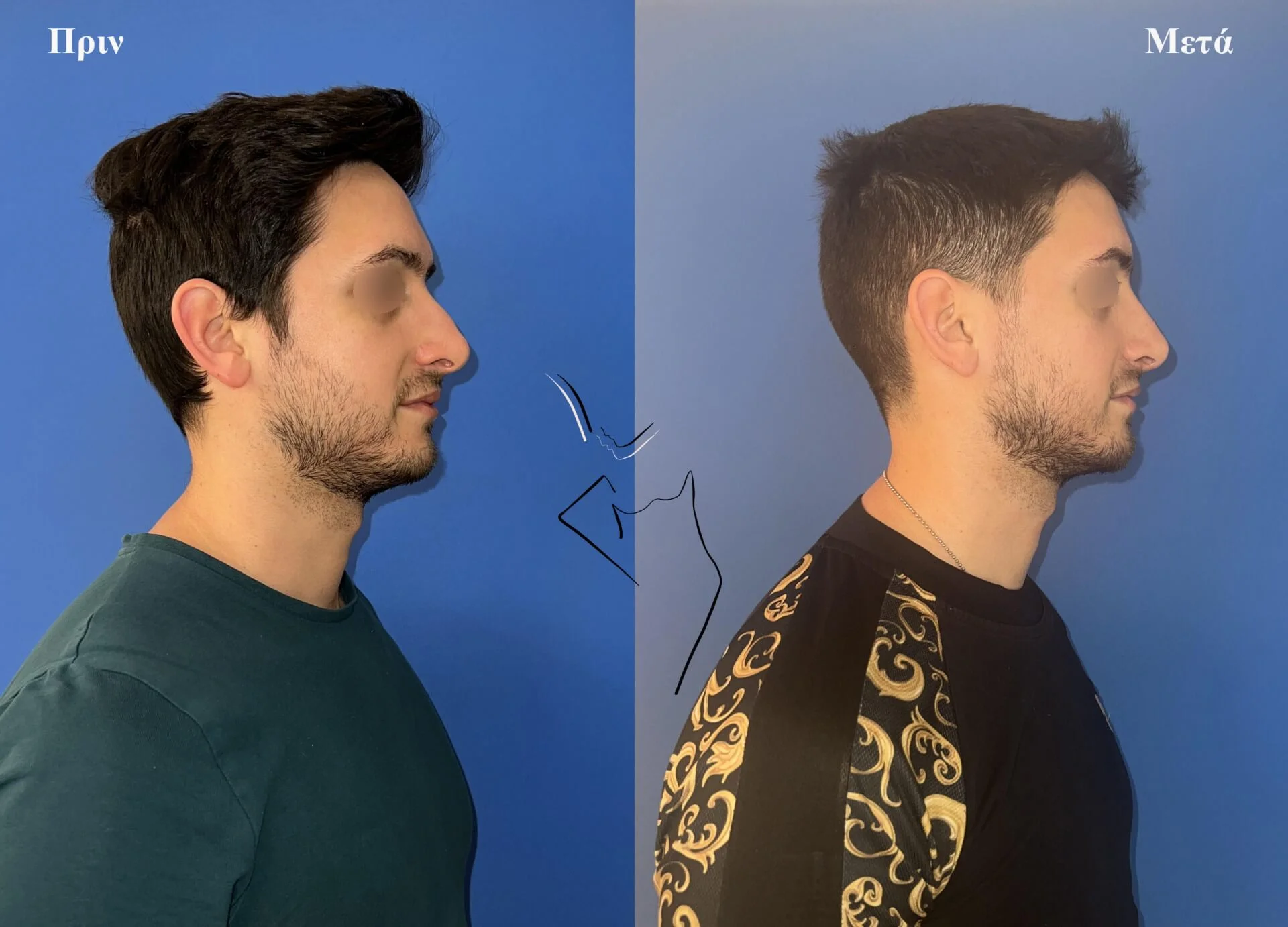 Ρινοπλαστική2α