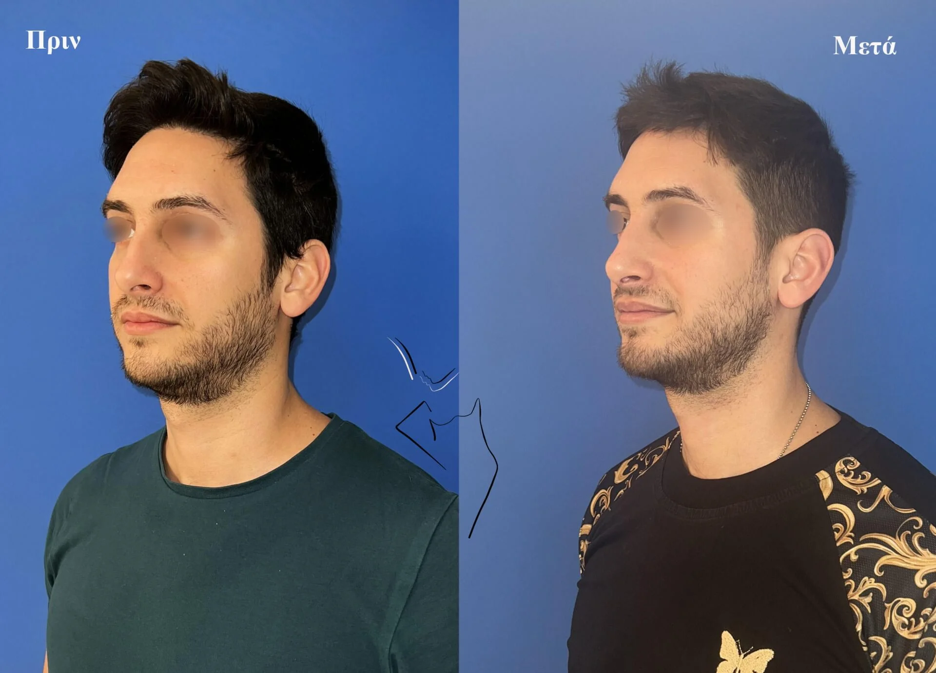 Ρινοπλαστική2β