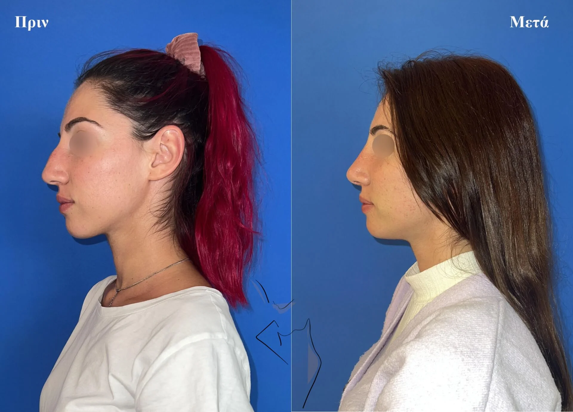 Ρινοπλαστική5α