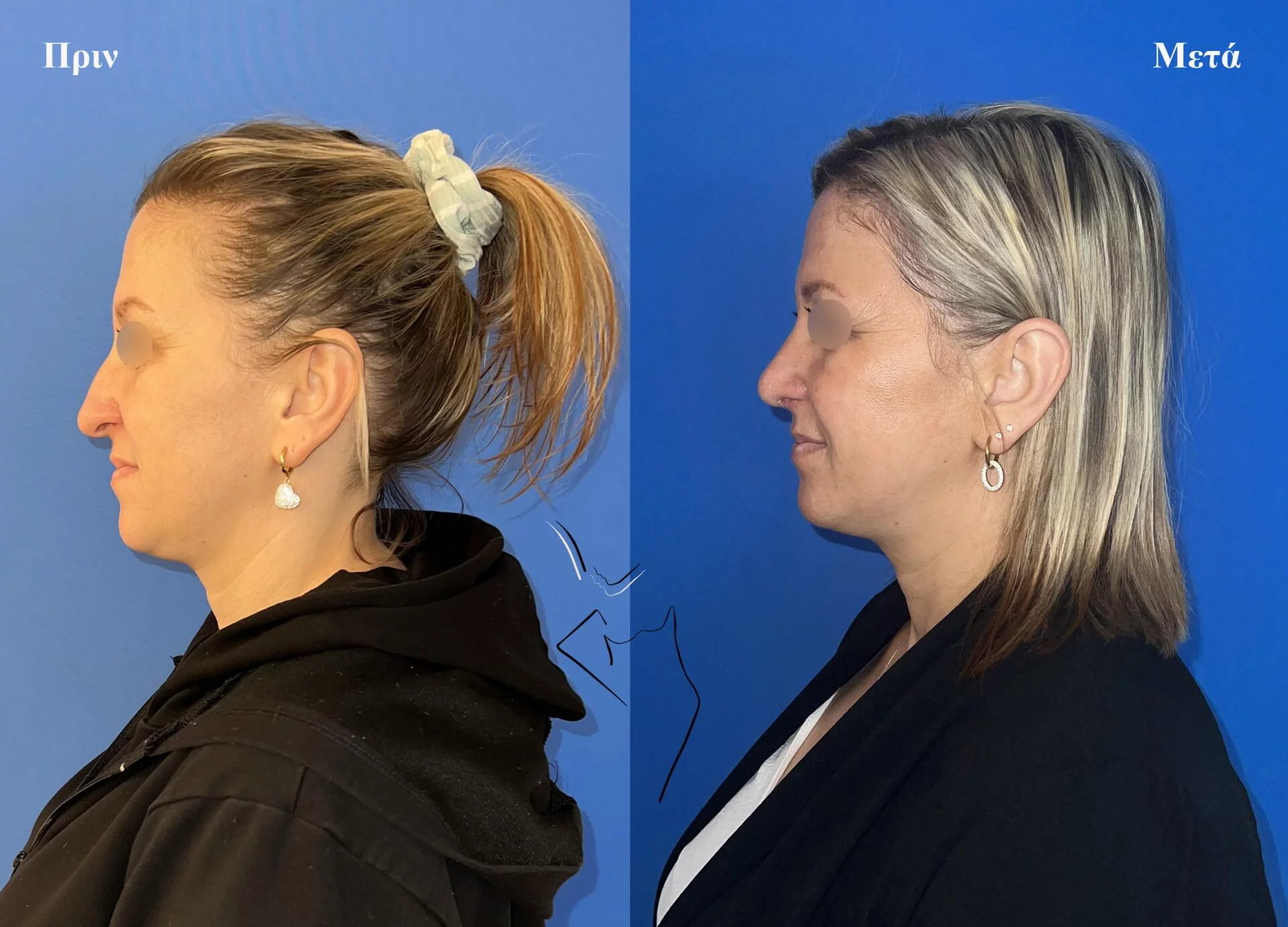 ρινοπλαστική1β