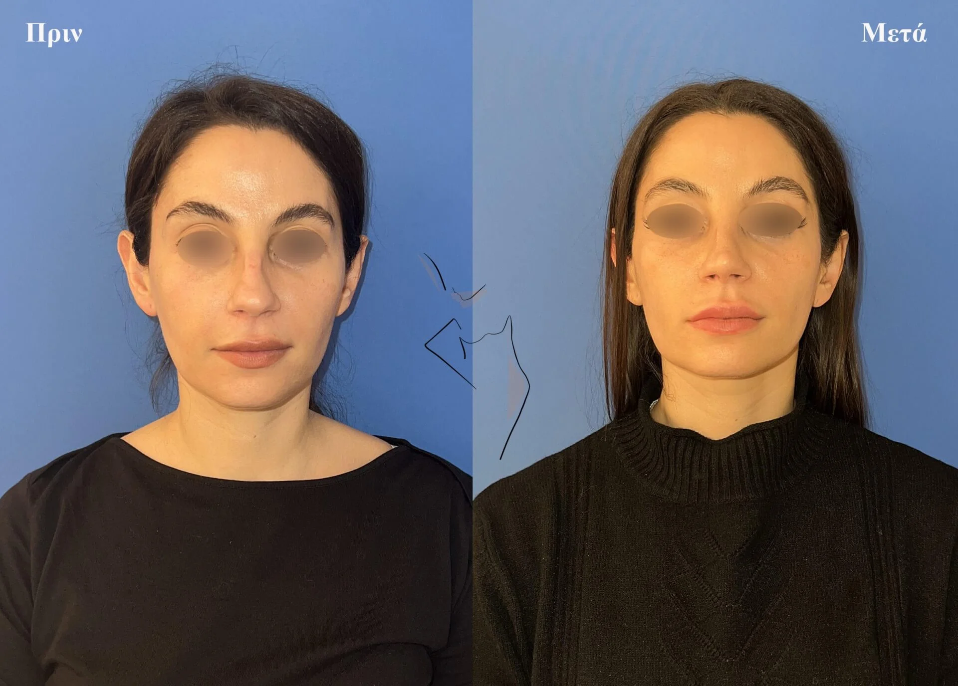 ρινοπλαστική3α