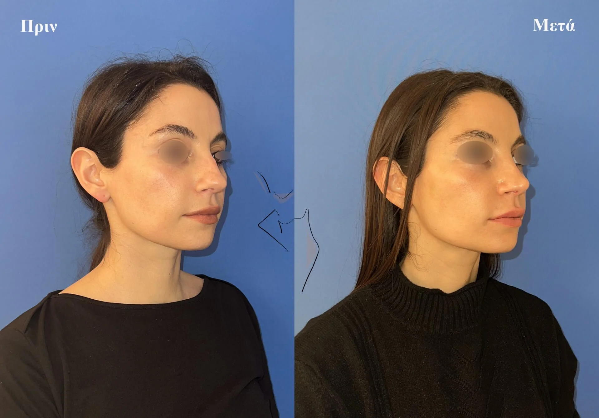 ρινοπλαστική3β