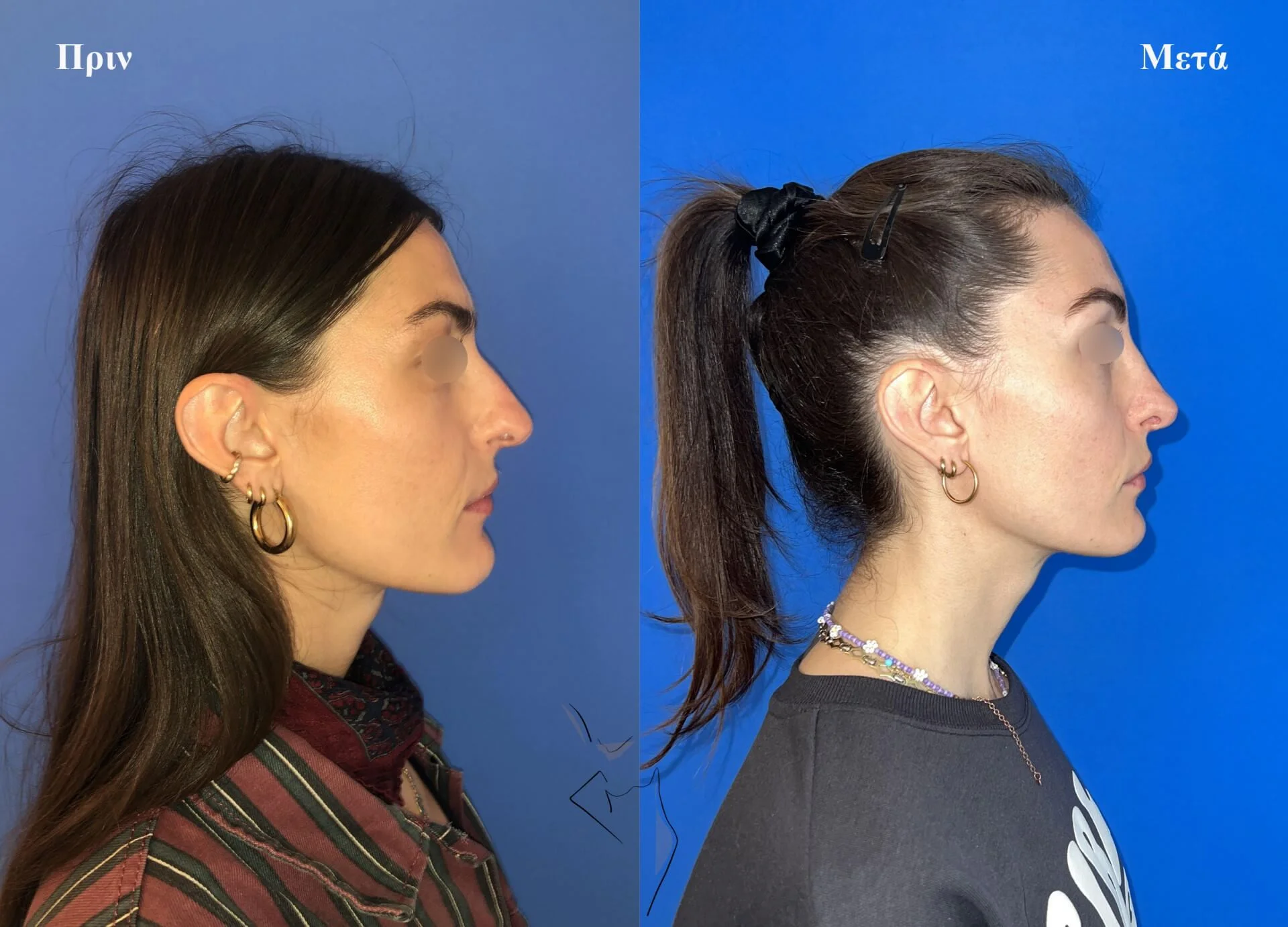 ρινοπλαστική4