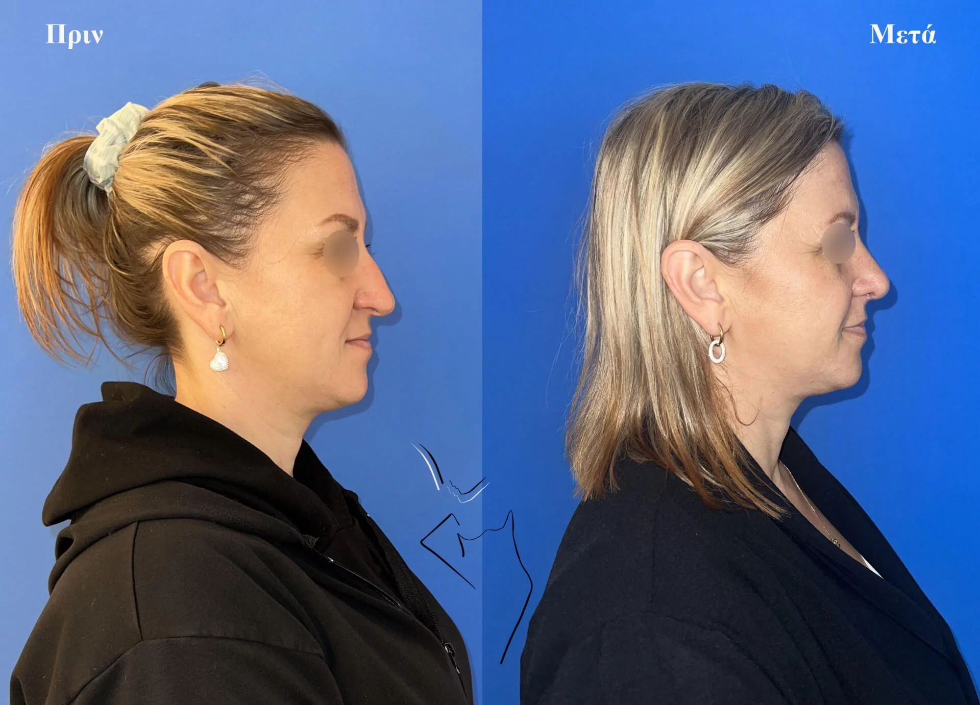 ρινοπλαστικη1α