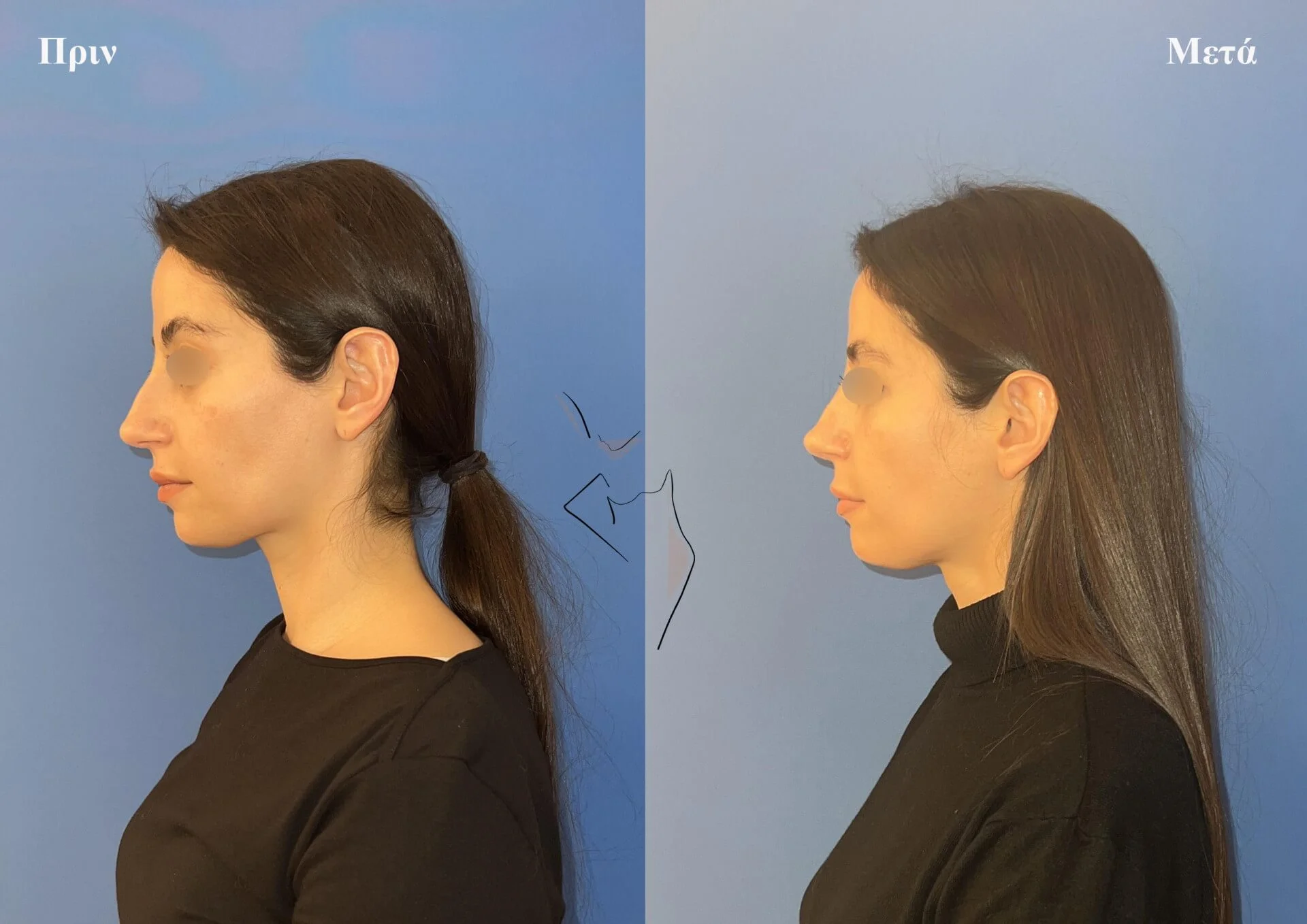 ρινοπλαστικη3γ