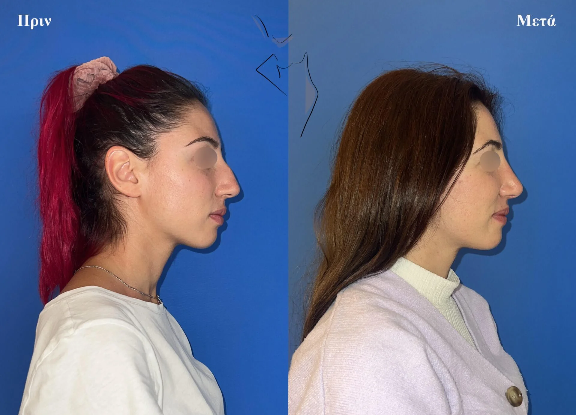 ρινοπλαστικη5β